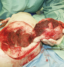 Soft tissue sarcoma intra-op