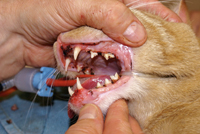 Epulis removed with CO2 laser