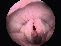 Perilaryngeal tumors
