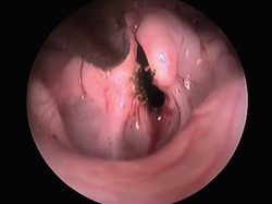 Reoving lesions witha CO2 laser and video otoscope