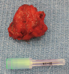 anal sac carcinoma