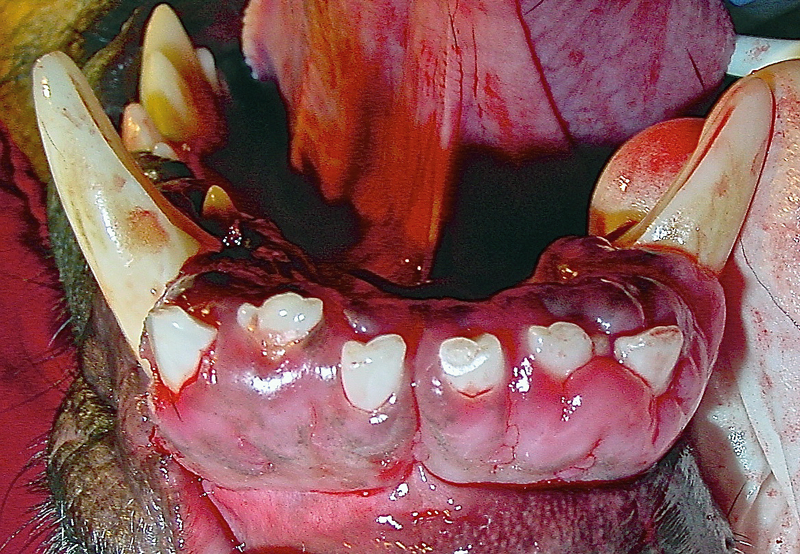 Figure 3: The mandibular incisor teeth are nearly covered with enlarged gingiva, resulting in pseudopockets around each of the mandibular incisors. Note also the gingival enlargement on the lingual surface of the mandibular canine teeth.