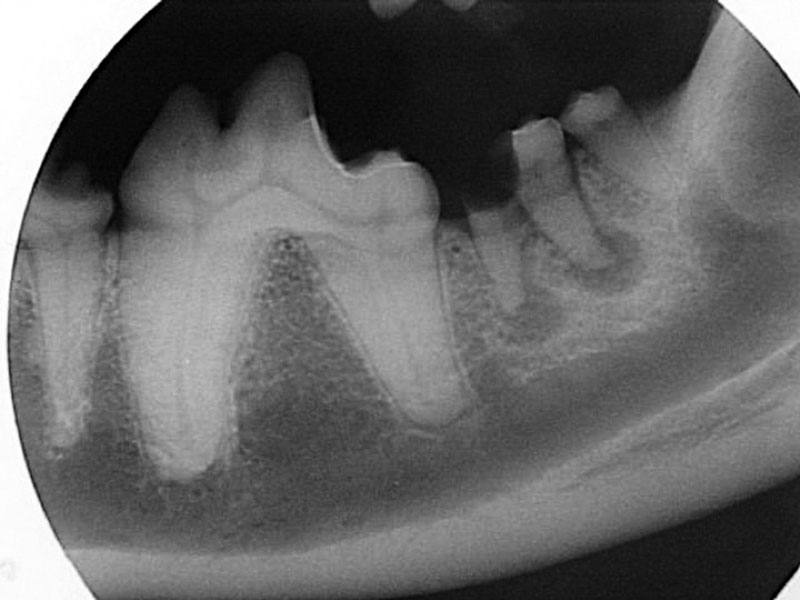 Radiograph of a severe caries lesion of the left mandibular second molar (tooth 310). The degree of crown loss is significant, and the caries bacteria have extended into the endodontic system, resulting in endodontic infection at the apices of the roots. 