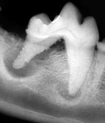 periodontal bone loss