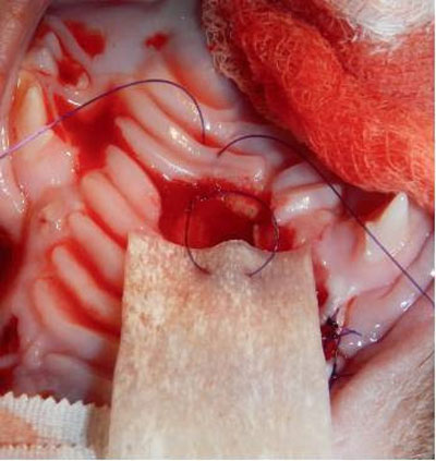 Figure 2: Initial suture placement of an allograft bone membrane before trimming the membrane to a size slightly larger than the size of the defect