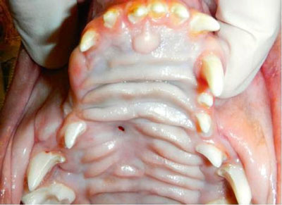 Figure 4: The hard palate 3½ months after placement of the bone membrane. A 3-millimeter defect remains, which may require closure in the future. The right maxillary canine, first premolar and second premolar teeth have not erupted, and some evidence exists of developmental abnormalities of the right maxillary incisors that may require further treatment.