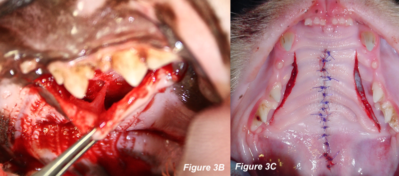 B.) Medially positioned double flaps are raised from their periosteal attachments of the bone of the hard palate by careful use of a periosteal elevator. Care is taken to not transect the major palatine artery during elevation to avoid possible problems with blood supply to the medially positioned flaps. C) Fresh edges are apposed with 5-0 poliglecaprone in a simple interrupted pattern. 