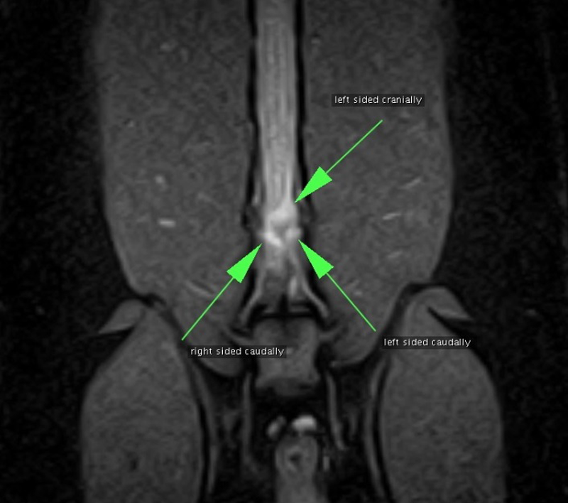 An MRI reveals a mass between L5 and L6.