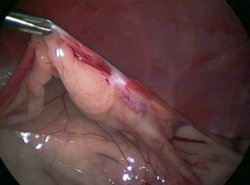 A suspended uterus