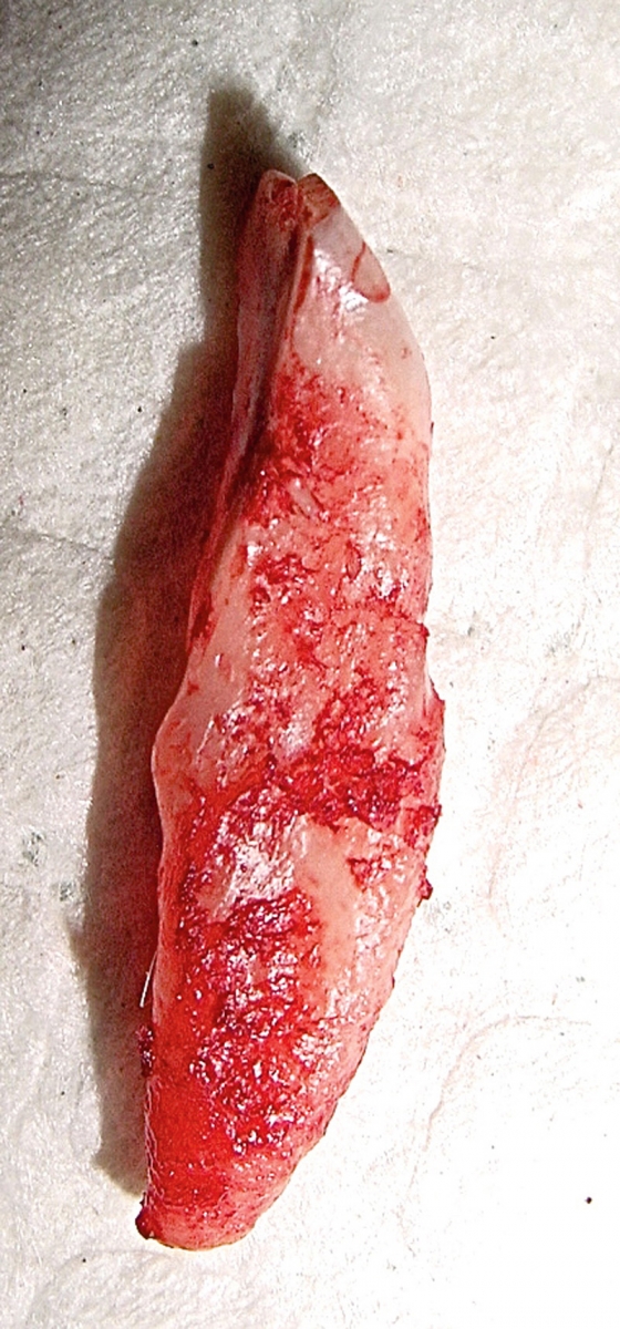 Photograph of one of the madibular incisor teeth that had been worn to a chisel point, resulting in trauma to the ventral tongue
