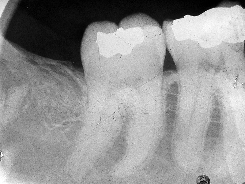 retained tooth root