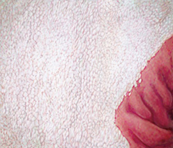 Preventing Ulcers Is A Matter Of Timing