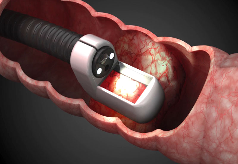 How Electrochemotherapy Opens Doors to Additional Treatment