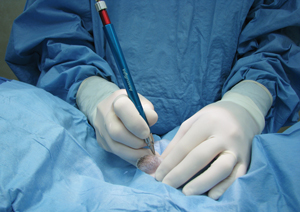 CO2 Laser Surgery: Standard Of Care