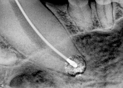 Root Canal Renaissance, 2008