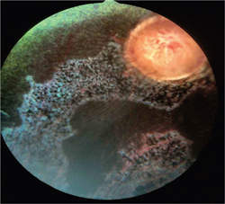 Treatments Advance For Corneal Disease, Injuries