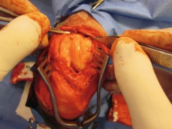 Early Surgery Is Good Patient Care