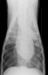 What’s Your Diagnosis? Mediastinal Abnormality