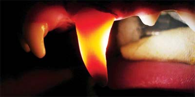 Shedding light on diagnostic transillumination