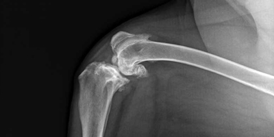 Treating pain without pain medications