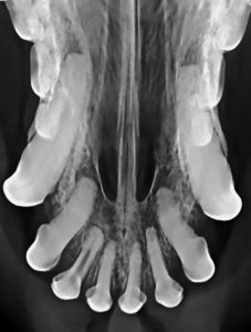 An incidental finding of a nonvital tooth (#102) as evidenced by an inappropriately wide canal. Nonvital teeth should be extracted or endodontically treated.