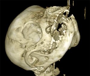 Three-dimensional reconstruction of a cone-beam computed tomography (CBCT) scan showing comminuted fractures of the maxilla, nasal bones, and frontal bones.