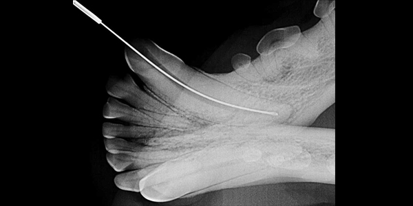 Talking shop with a human endodontist: Rotary and reciprocating endodontic files