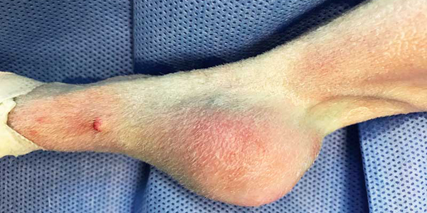 How should you handle lumps and bumps?