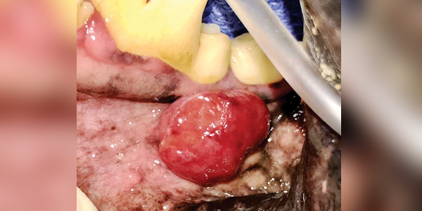 Another zebra diagnosis: Granulomatosis with polyangiitis