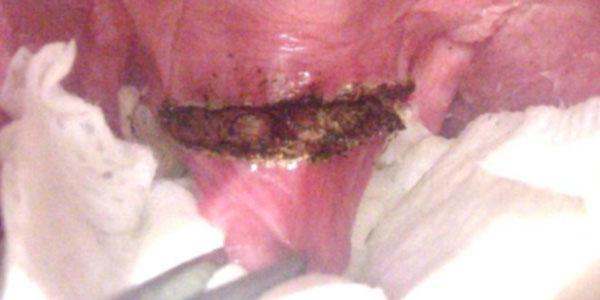 Lasering in on a better approach for BOAS patients