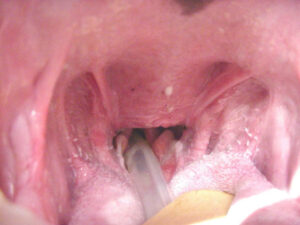 Completed resection of the redundant soft palate. Note the excellent hemostasis and absence of sutures.
