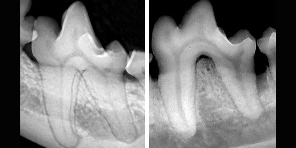 How you can prevent iatrogenic mandibular fractures