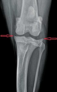 Osteophytes on the lateral and medial edges of the tibial plateau (arrows).
