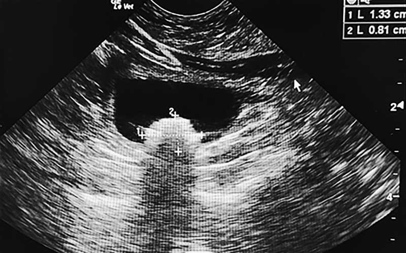 Figure 2: Cystolith in the urinary bladder of a cat. Photo courtesy Heather Sims