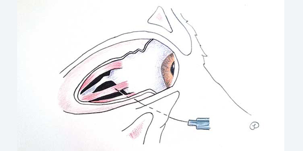 A look at analgesia for enucleation — with web-exclusive videos