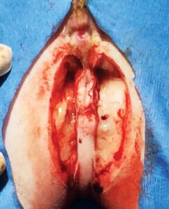 Figure 4: Two matching incisions are made, so the skin folds are removed.