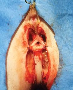 Figure 5: The first two sutures are placed in the skin lateral to the vulvar opening and attached to the corresponding lateral side of the incisions.