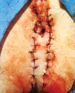 Figure 6: The remainder of the skin defects are closed with 4-0 dissolvable suture material placed 1-2 mm apart. When completed, the area should be flat.
