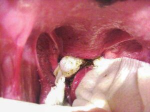 Resection from right to left along the line of the initial partial thickness incision.