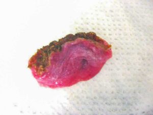 Excised redundant soft palate.