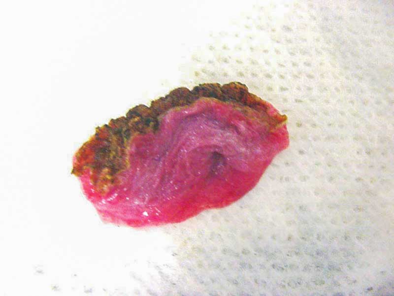 Excised redundant soft palate.