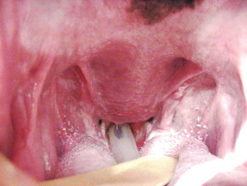 Elongated soft palate extending into the laryngeal opening.Photos courtesy Ray Arza