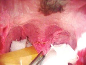 Line of incision marked with a series of laser pulses.