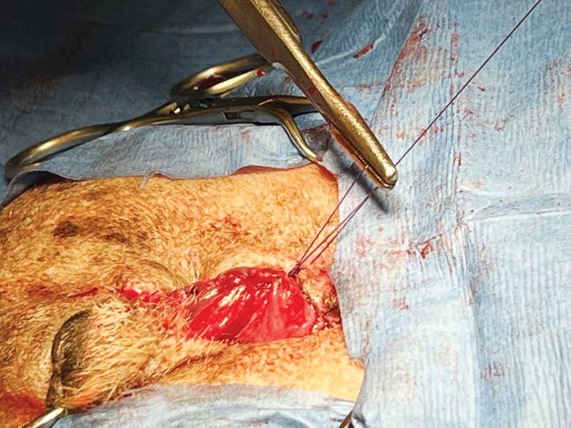 Figure 4: The bladder wall is completely closed prior to removing the tether sutures.