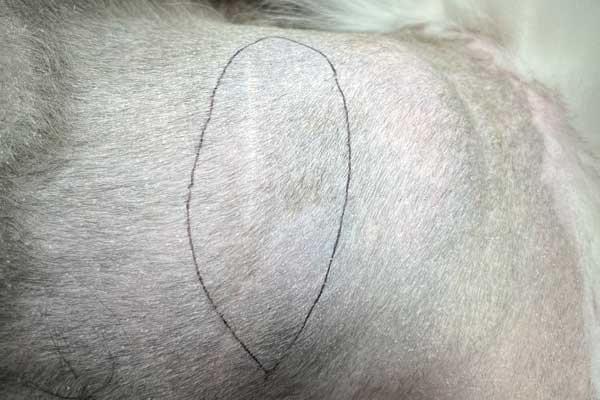 Six steps for easier lipoma removal