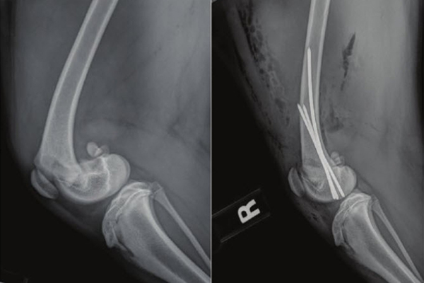 Early interventions aid in juvenile fractures