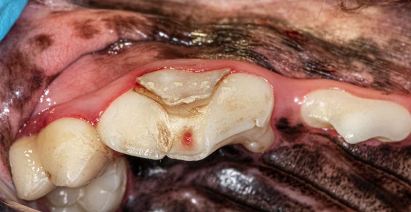 Crown root fracture