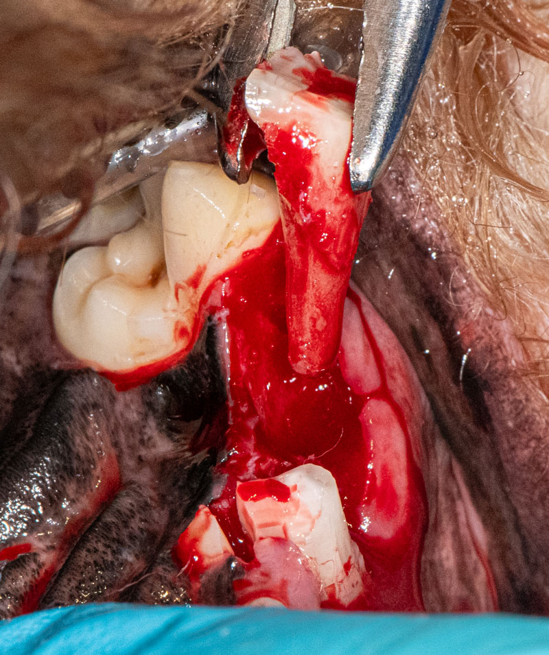 Delivery of mesial root.