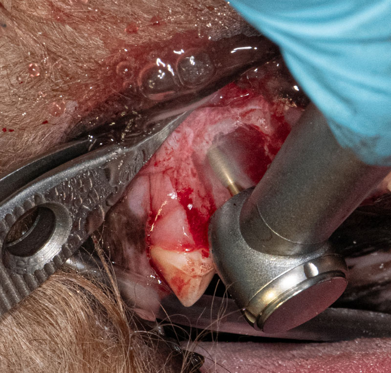 Alveolarplasty to smooth down the alveolar crest