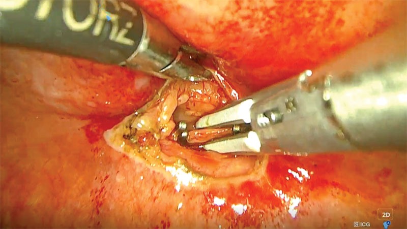 Minimally invasive surgery techniques improve idiopathic chylothorax treatments